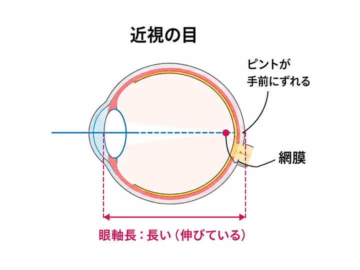近視の目の構造