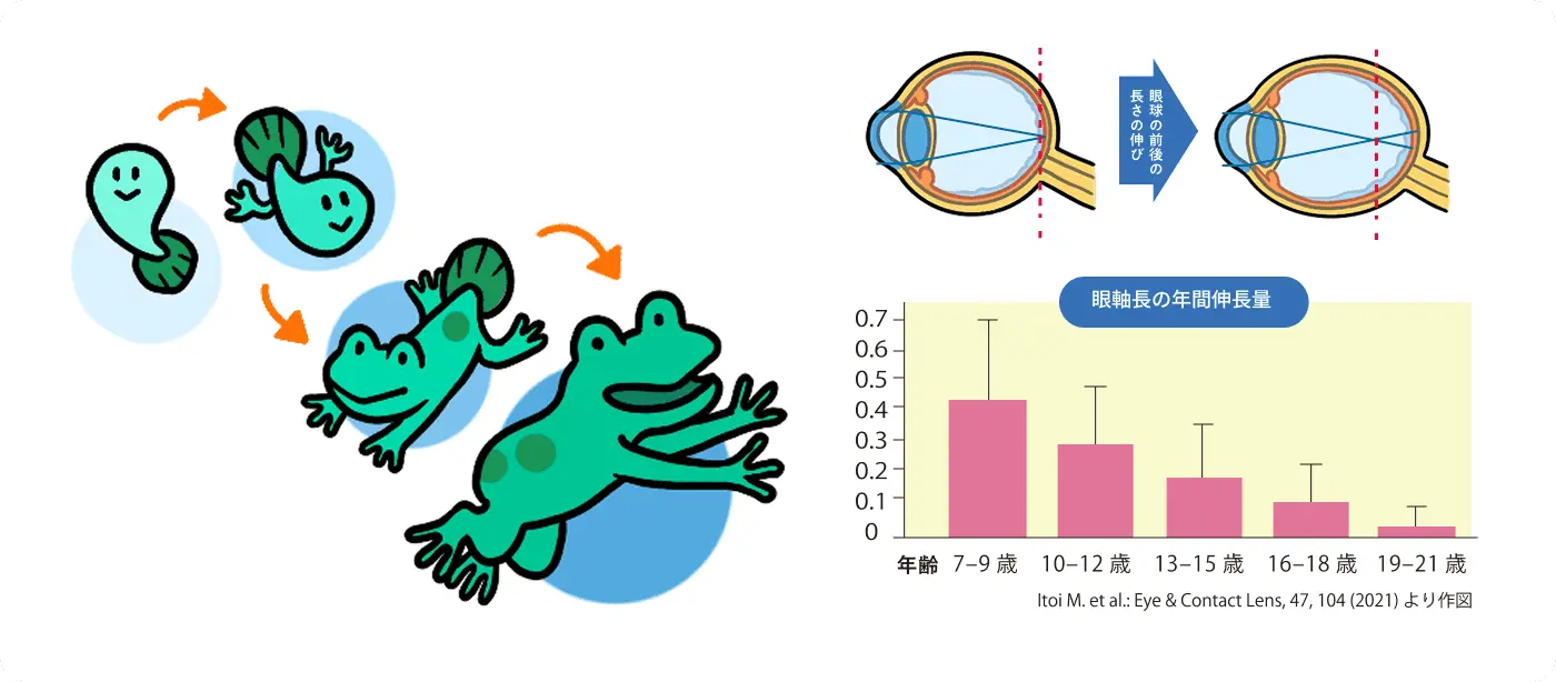 近視の進行イメージ図